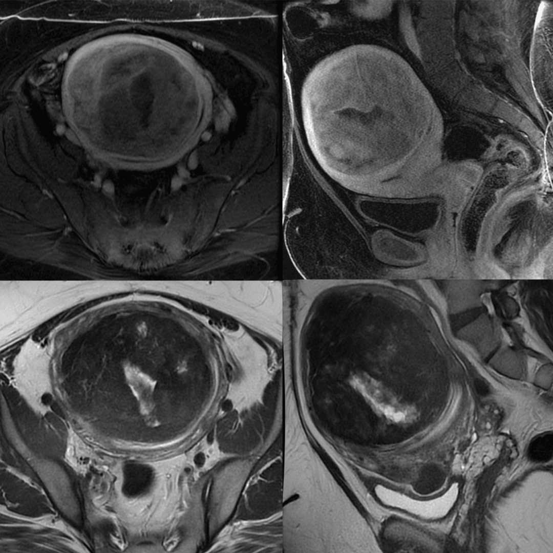 Imagerie par résonance magnétique d'une femme avec des fibromes utérins / Magnetic Resonance Images of Woman with Uterine Fibroids